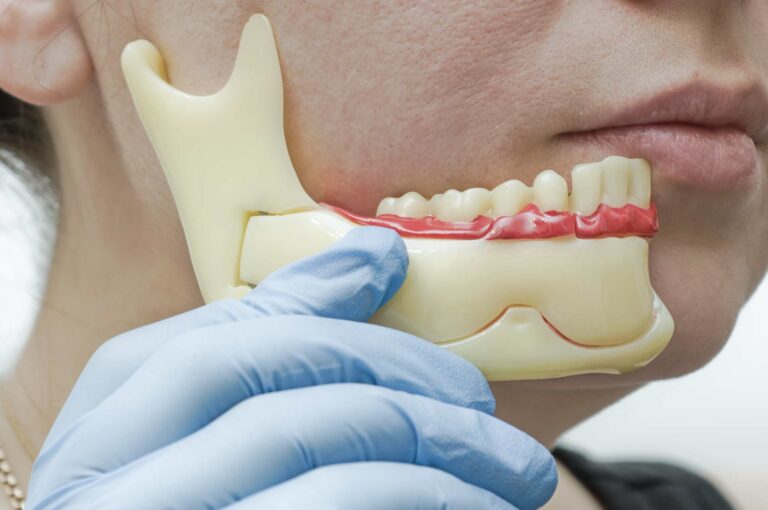 Waarom verandert mijn gezicht met een kunstgebit?